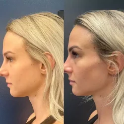 Jawline-Contouring-with-Morpheus8.webp